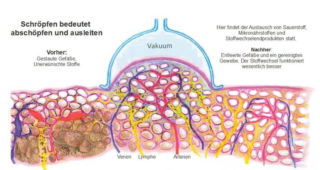 Mit einem Schröpfgerät wird die Vakuumstärke individuell eingestellt. So kann man auch sanft arbeiten. Hämatome entstehen nur dort, wo das Gewebe übersäuert ist. Durch Übersäuerung kann das Blut verdicken und sich in den feinen Kapillargefäßen wie abgebildet stauen. Beim Schröpfen wird das gestaute Blut herausgedrückt. In der TCM Medizin spricht man vom „schmutzigen Blut“. An diesen Stellen können Hämatome entstehen. Das ist eine positive Erstverschlechterung - das Immunsystem wird aktiviert - Fresszellen (Leukozyten, Lymphozyten, Makrophagen und Gallensaft) reinigen den Bereich zwischen den Zellen. Das Lymphsystem transportiert alles ab. Ausreichend reines Quellwasser trinken unterstützt diesen Prozess. Ebenso eine basische Ernährung. Nach 3 - 5 Schröpfmassagen (1x wöchentlich)
entstehen an diesen Stellen keine Hämatome mehr, selbst bei stärkerem Vakuum nicht. Außer bei Einnahme von Blutverdünnern.

Warum? Der Stau mehr in den Gefäßen und
das Gewebe hat sich offensichtlich gereinigt.

Rechtlicher Hinweis: Es gibt unzählige Erfahrungswerte, jedoch noch keine wissenschaftliche Studie. Im Falle von Krankheiten fragen Sie bitte einen Arzt Ihres Vertrauens.
